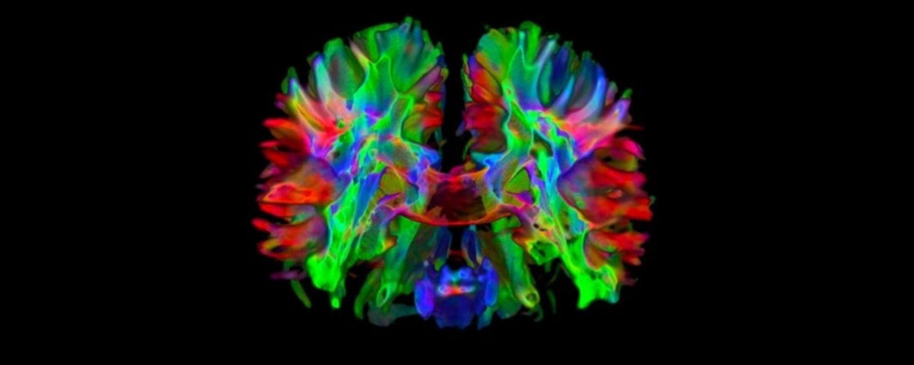 MRI brain scan