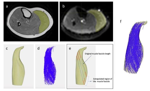 MRI of muscle